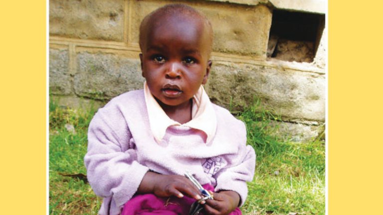 Clubfoot